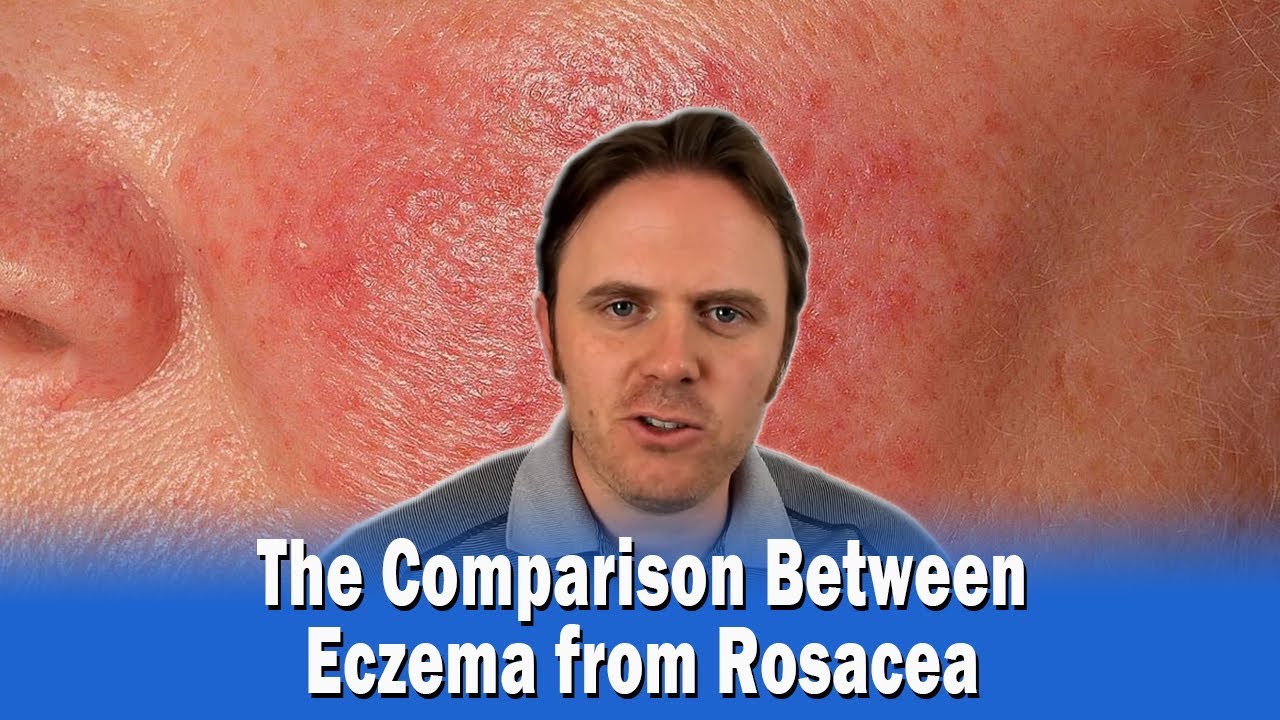 The Comparison Between Eczema from Rosacea YouTube
