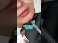 【ケツアゴの治療】映像から伝わる技術の高い医師の腕！ヒアルロン酸でアゴの丸みを形成していく！