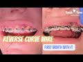 What does a reverse curve wire do for braces? 1 Month Check Up - Tooth Time Family Dentistry
