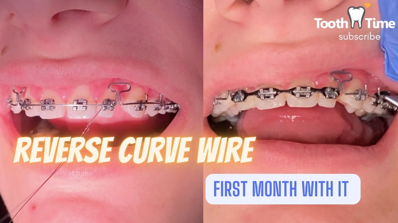 What does a reverse curve wire do for braces? 1 Month Check Up