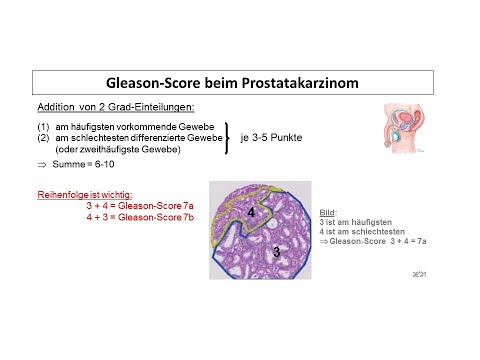 Video: Prostatakrebs Verstehen: Die Gleason-Skala