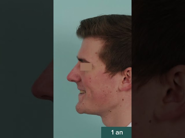 Rhinoplastie ultrasonique - Correction de défauts