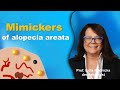 Diseases that may look like alopecia areata