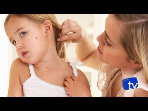 Vídeo: Rubéola Em Crianças - Sintomas, Tratamento, Vacinação, Sinais