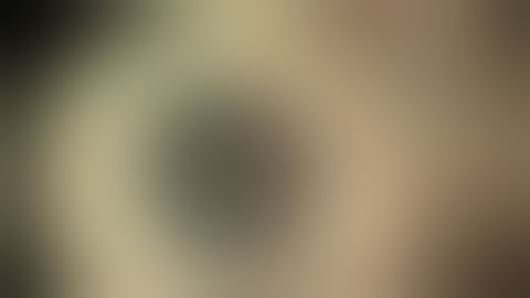 IOL repositioning with Trabecular aspiration for Pigment Dispersion Glaucoma by Steven G. Safran MD