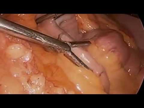 Real Gastric Bypass