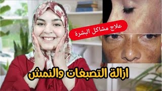 وأخيرا أنجح وصفة طبيعية الإزالة الكلف والبقع الداكنة من الوجه وتوحيد لون البشرة? جربي وحكمي4K