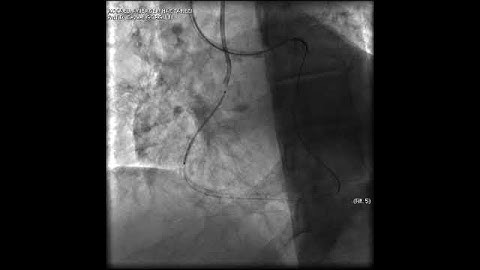Aortic dissection and radial rupture during retrograde CTO PCI: Management of complications VİDEO 25