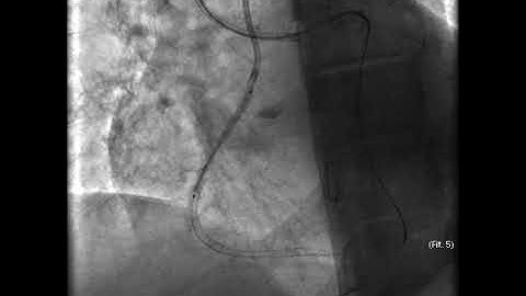 Aortic dissection and radial rupture during retrograde CTO PCI: Management of complications VİDEO 25