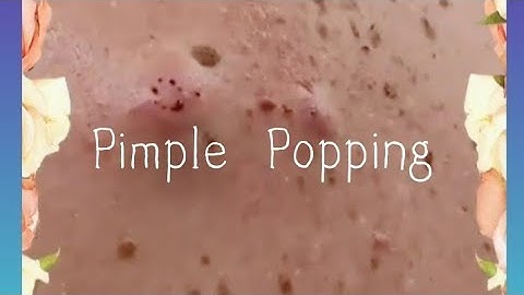 Pimple & Blackheads Popping - 39