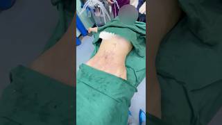 #Waist and abdomen circumference #liposuction #Thigh liposuction