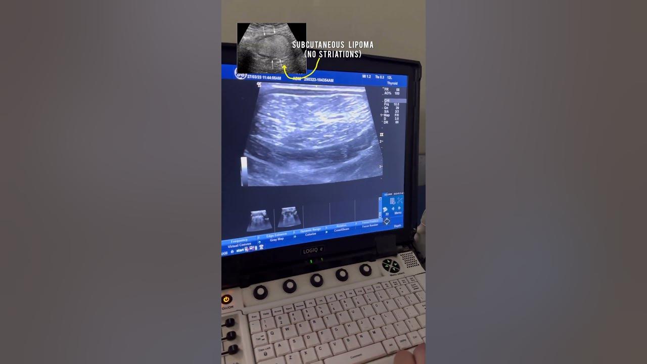 lipoma-ultrasound-intramuscular-deep-seated-lipoma-looks-different-from