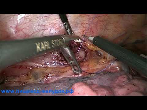 Видеоторакоскопическая (VATS) энуклеация лейомиомы пищевода