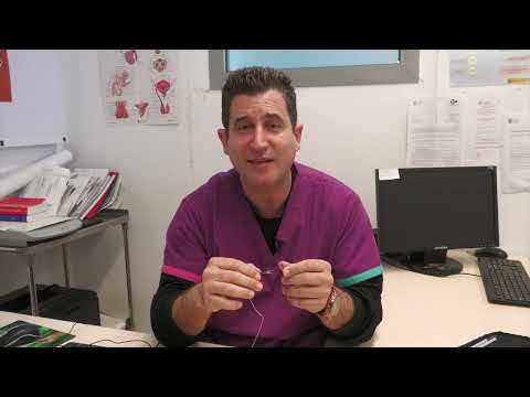 El HUCE comienza a realizar la técnica i-TIND para lahiperplasia benigna de próstata