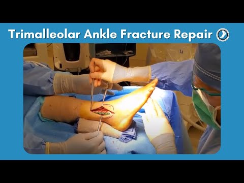 Trimalleolar Ankle Fracture Repair