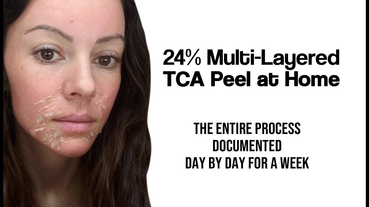 Multi Layered TCA Peel Demo Pain Progress Results YouTube multi-layered-tca-peel-demo-pain-progress-results-youtube