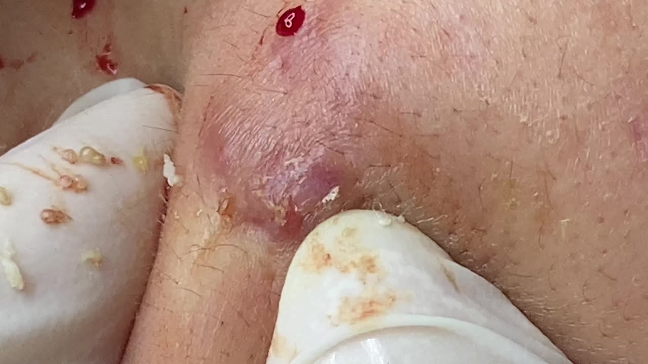 Acne Treatment | Điều Trị Mụn - SacDepSpa#92