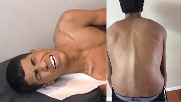 Chiropractor CHANGES LIFE for TEENAGER w/ HUNCHBAC...