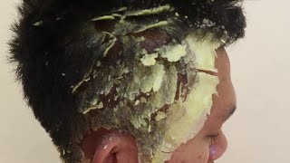 Rahatlatıcı kepek soyma videosu(egzema,dünyanın en kepekli insanı)