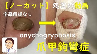 【ノーカット】爪甲鉤彎症（そうこうこうわんしょう）の処置動画　字幕解説なし　【巻き爪・陥入爪治療の相談室】　Treatment of　onychogryphosis　（uncut video）