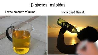 Diabetes insipidus Symptoms, causes and treatment. Diabetes insipidus vs diabetes mellitus