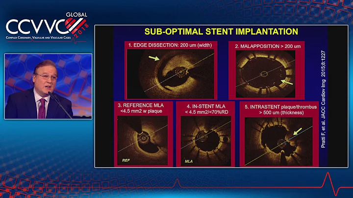 Coronary Physiology and Imaging: OCT-Guided PCI May Be Better