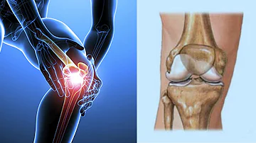 ¿Cómo se recupera el cartílago de la rodilla?