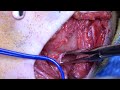 Branchial cleft cyst removal