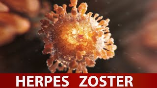 Herpes zoster Patofiziologija, simptomi, pomoć  Dr#75