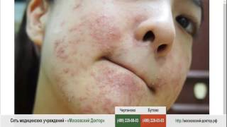 Аллергия на маску для лица видео Аллергия на лице