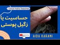 حساسیت پوستی الرژی دون دون شدن پوست دور ناخنو سوزش و خارش چیست جوشهای ریز قارچ هستند یا الرژی حساسیت پوستی الرژی دون دون شدن پوست دور ناخنو سوزش و خارش چیست جوشهای ریز قارچ هستند یا الرژی