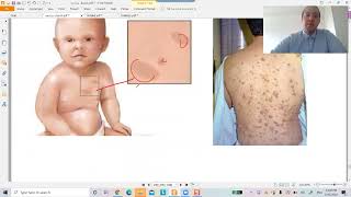 Neurology Review 4 NCS  Neurofibromatosis Type 1 vs Type 2 Dr Fadi Qutishat 2020