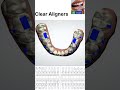 Clear Aligners #aligner #dentist#DRIshratMafruha #Denta #shorts #funny #machine #dental