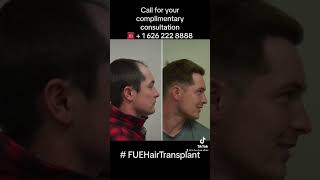 Before and After FUE Hair Restoration with LA FUE Hair Clinic. 6 months update with 3200 FUE grafts.
