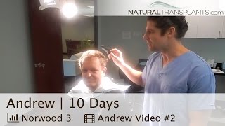 10 Day Fut Strip Method Hair Transplant Surgery Post-Op Follow-Up, Natural Transplants Andrew