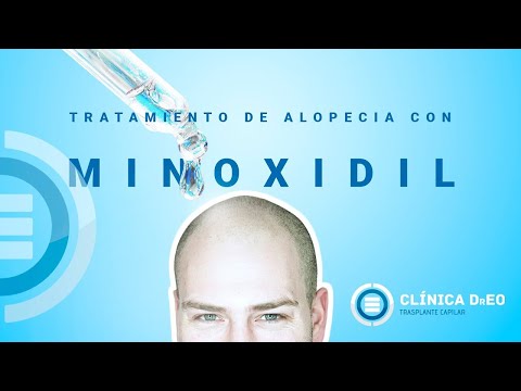 Minoxidil, ¿Saca Cabello Nuevo? ¿Es Estimulante Capilar? ¿O Qué hace? Aprende Todo Sobre su Uso