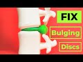 How to Fix A Bulging Disc -No surgery