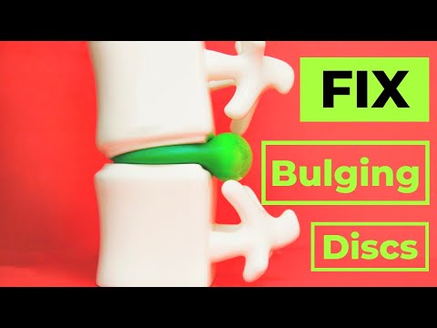 How to Fix A Bulging Disc -No surgery