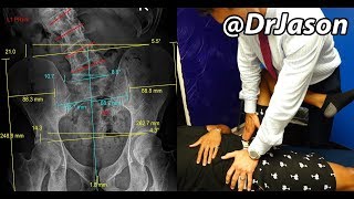 Dr. Jason - DETROIT MAN WITH SCOLIOSIS, FLAT FEET, BUNIONS, BACK SPASMS, *COMPLEX CASE* (Part 2)