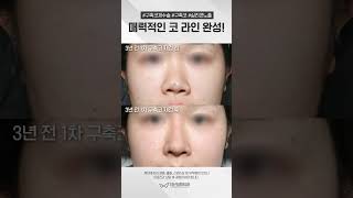 코수술 부작용 구축코로 스트레스 받고 계신가요?