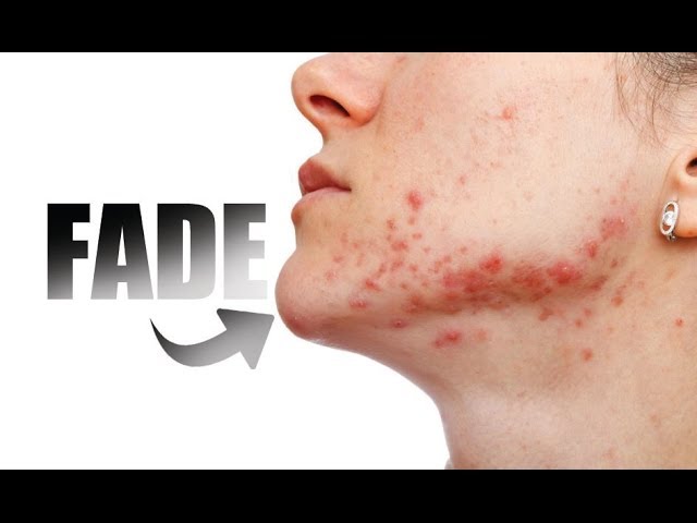 Datter peregrination Helt tør HOW TO FADE PURPLE RED MARKS FROM ACNE - YouTube