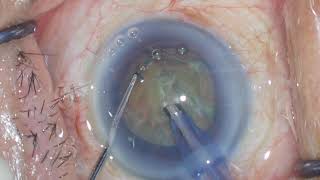 Modified Stop and Chop Phaco Grade 3/4 Cataract