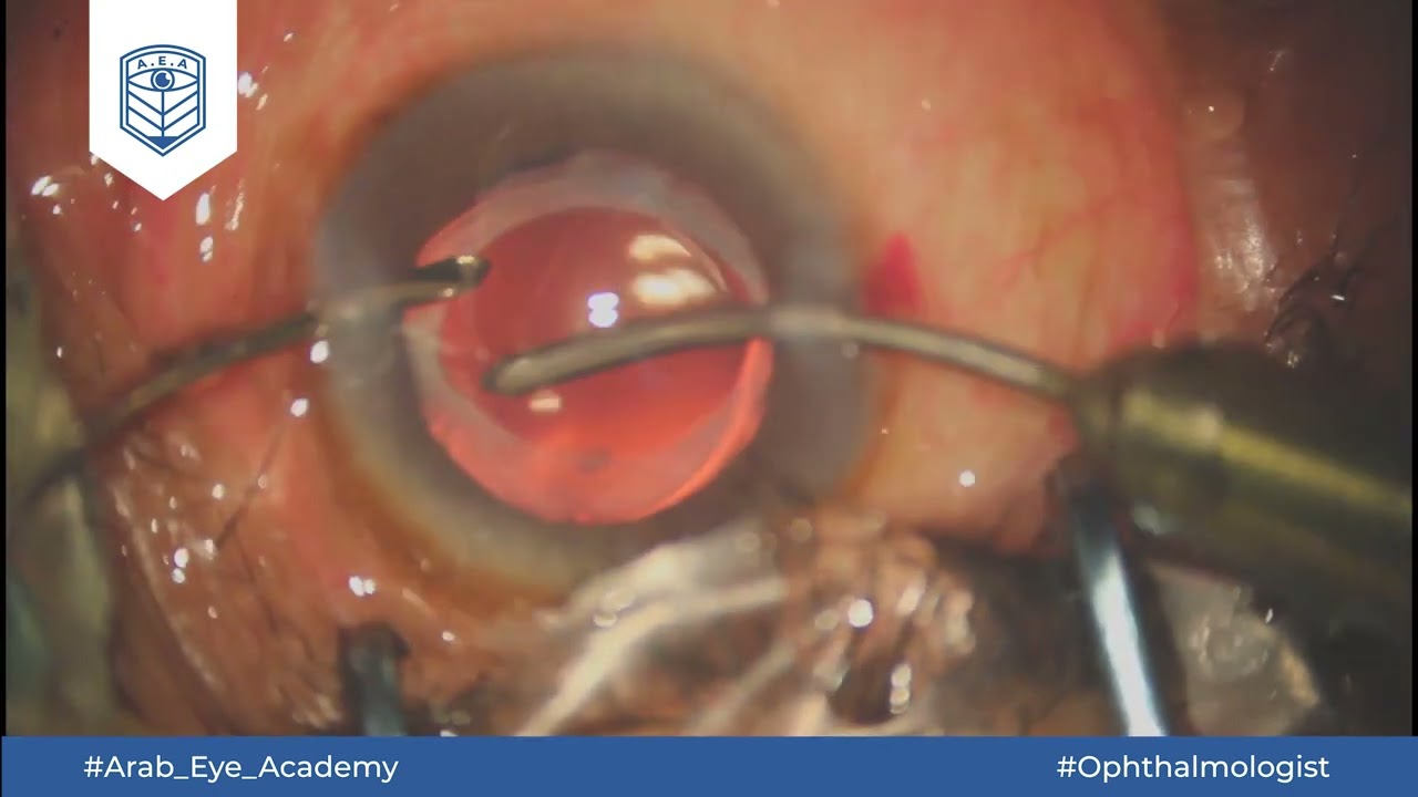 Educational Video 8: Late capsular block syndrome by AEA