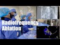 Radiofrequency ablation para sa abnormal heartbeat