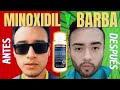 ✅ MINOXIDIL y BARBA | 🛑 7 Errores que cometes al aplicar Minoxidil 🛑 | Opinión Médica 👨‍⚕