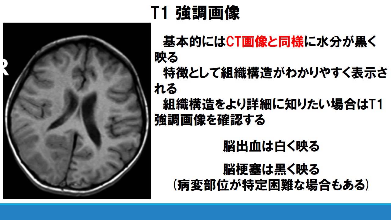No 11 CT・MRIの特徴及び脳血管疾患に対する画像選択 - YouTube