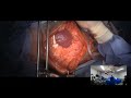 Live stream  exploratory surgery for intestinal foreign body in a dog