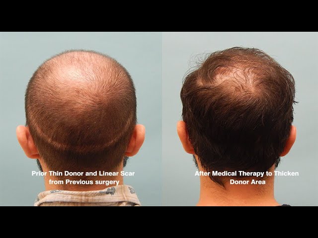 Extracellular Vesicles for Hair Growth - Patient Hair Loss Journey