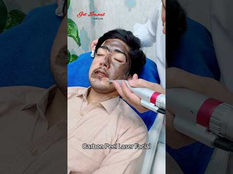 Carbon Peel Laser