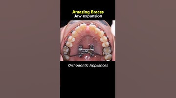 Amazing braces - Jaw expansion with orthodontic appliances #braces #dentist